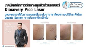 เทคนิคหลักการรักษาหลุมสิวด้วยเลเซอร์ Diacovery Pico Laser ของหมอรุจได้รับการเผยแพร่ในระดับนานาชาติของทางบริษัทระดับโลก Quanta System จากประเทศอิตาลีครับ